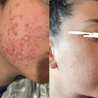 چگونه جوش رو صورت درمان کنیم