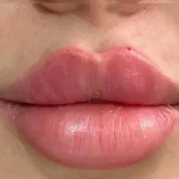 تزریق ژل و بوتاکس و انواع مزو ژل و مزو مو