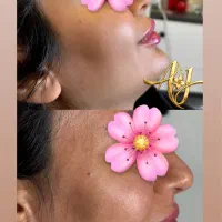تخفیف ویژه بوتاکس فقط تا پایان فردا