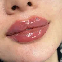 تزریق ژل و بوتاکس