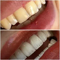 کامپوزیت/لمینیت/ایمپلنت/ارتودنسی