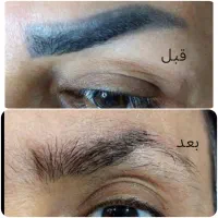 ریموو درمانی آرایش دائم