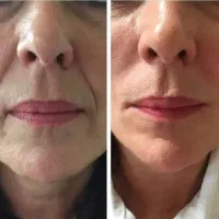 پاکسازی جوانسازی صورت