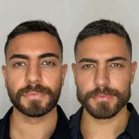 ژل بوتاکس جوانساز مزوتراپی،چربی‌سوزی شکم،پهلو
