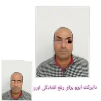لیپوساکشن