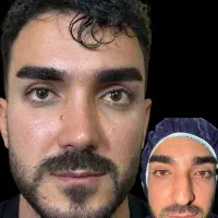 عمل بینی رینوپلاستی(شروع از ۳۳ تومن)+مشاوره رایگان