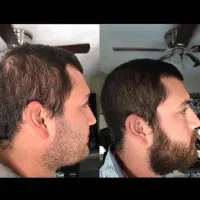 ریزش مو را متوقف کن