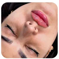 ژل بوتاکس چربی غبغب مزوپی ار اگروزوم سابسیژن آموزش