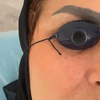 تخفیف ریمو (پاک کردن تتو) ابرو در کلینیک زیبایی