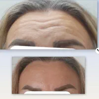 تخفیفات ژل بوتاکس مزو میکرو