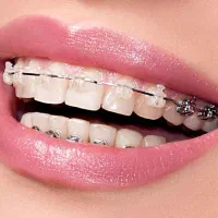 ارتودنسی باکمترین هزینه /شرایط اقساط/بدون سود