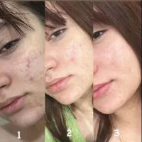 هرگز بوتاکس نکنید