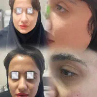 لیزر فیلر بوتاکس چربی با 40 درصد تخفیف