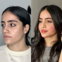 ژل،بوتاکس،چربی،پاک کردن تتو