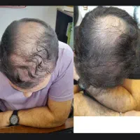 پی آر پی ممنوع