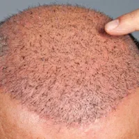کاشت مو بسیار اقتصادی