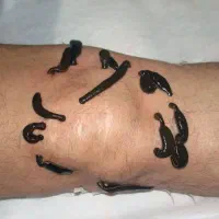 خدمات طب سنتی ، حجامت ، فصد ، زالو ، سم زدایی