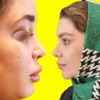 جراحی بینی قیمت ویژه