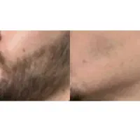 محلول پرپشتی و حجم اوری ریش
