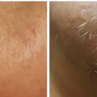 الکترولیز تخصصی موهای سفید و مشکی مقاوم
