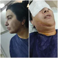 لیزرتاتوبوتاکس بیوفیلرالکترولیزخال لیزرموی پرسینگ