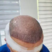 کاشت مو. ریش.وابرو