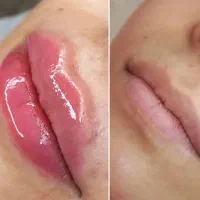 جشنواره لیزروجوانساز(هایفو،RF،اندولیفت) ژل بوتاکس