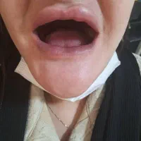 دندان مصنوعی /دندانسازی/اوردنچر/ژله ای/اقساط
