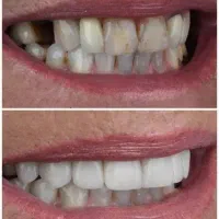 ایمپلنت لمینت عصبکشی و روکش با شرایط اقساطی