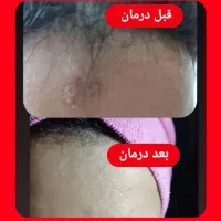 بهبود زگیل با طب سنتی شرقی آسیا