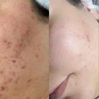 لیزر موهای زائد،،خدمات زیبایی