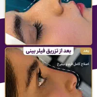 بوتاکس و فیلر چناران /جوانساز با قیمت های مناسب