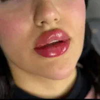 مدل جهت ژل لب، آنزیم ،بوتاکس،جوانسازی صورت ،