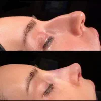 عمل بینی اقساطی جراح گوش و حلق و بینی