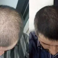 بدون کاشت هم درمان میشی