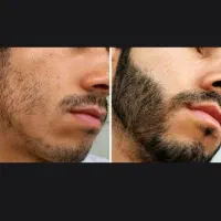 پسرایی که کم پشتی ریش دارن
