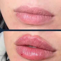 هایفو + prp رایگان الینا