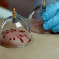 انواع حجامت