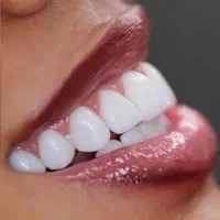 جشنواره دندانپزشکی عصب کشی کامپوزیت لمینیت ایمپلنت