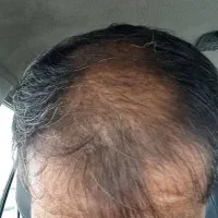 با کاشت بدتر میشه
