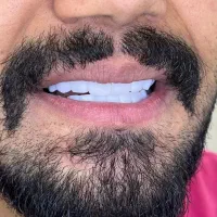 کامپوزیت دندان فقط ۱/۴۰۰ اقساط بدون پیش پرداخت