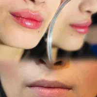 تزریق تخصصی لب -کانتور - بوتاکس - نخ
