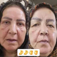 جراحی بلفارو پلاستی