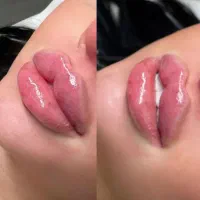 جشنواره بهاره  تزریق فیلر بوتاکس مزوتراپی اقساط