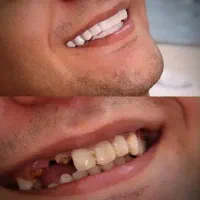 روپوش و لمینت دندان