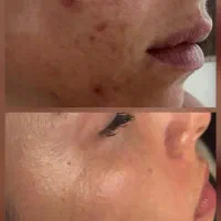 پاکسازی و فیشال پوست،رهایی از جوش،لک چین و چروک
