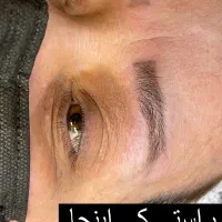 ریموو تخصصی در یک جلسه