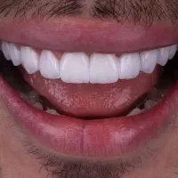 جشنواره تخفیفی کامپوزیت،لمینیت،روکش سرامیکی