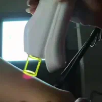 لیزر مو با دستگاه کندلا