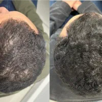 دائمی پر پشت کن